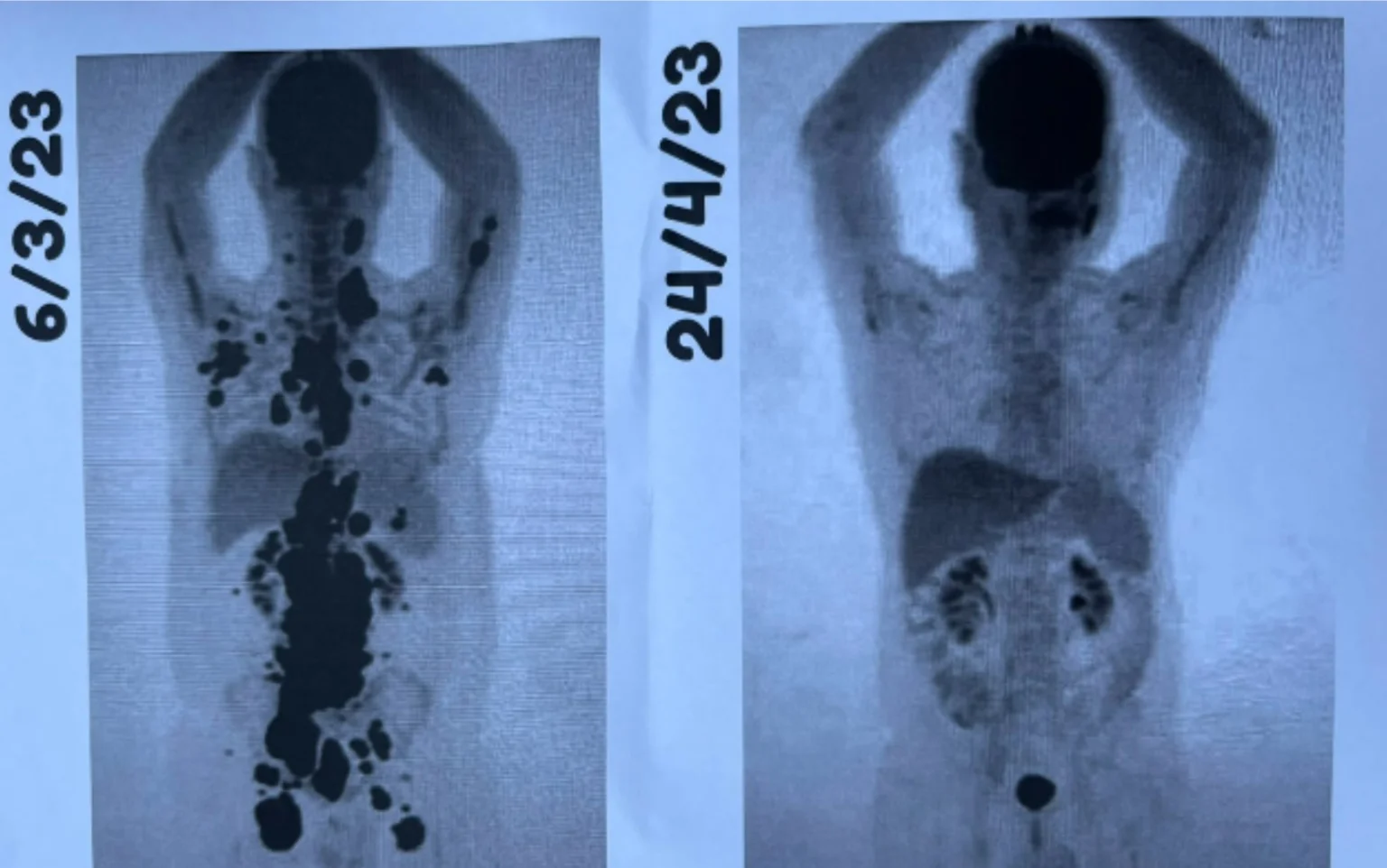 Paciente celebra remissão total do câncer após inovadora terapia celular: ‘Vitória após 13 anos de luta’