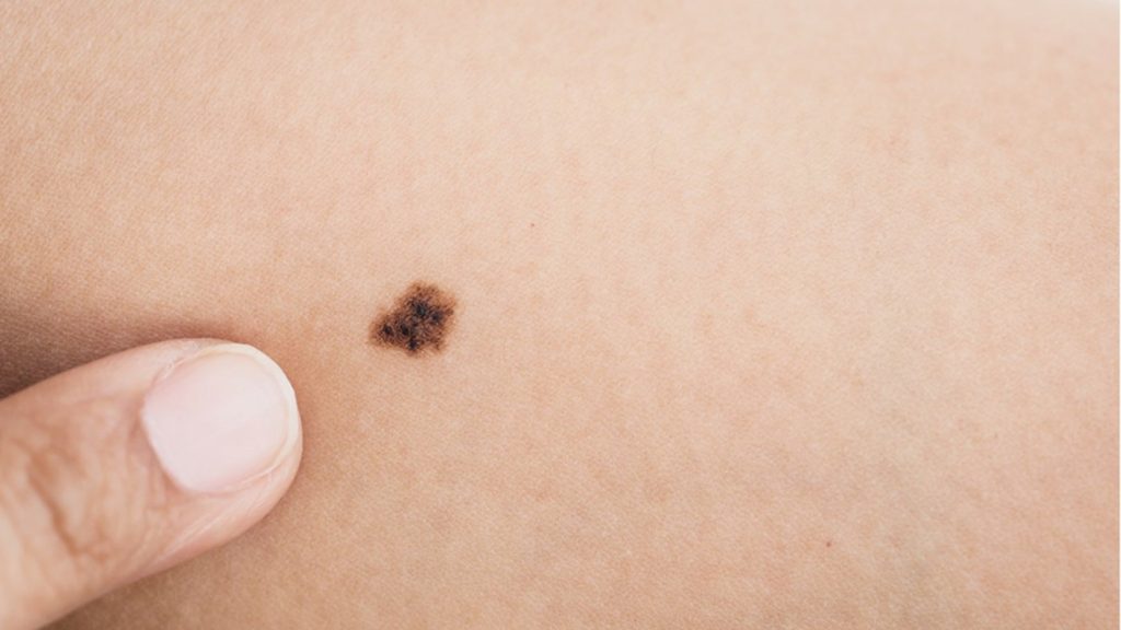 Tratamento inovador desenvolvido pela Unicamp promete revolucionar combate ao câncer de pele não melanoma