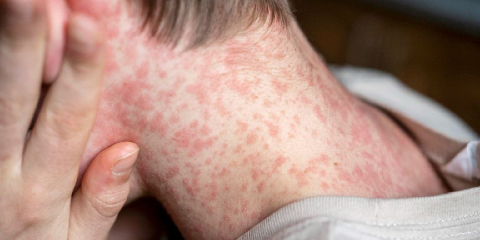 Sarampo: saiba mais sobre sintomas, prevenção e vacinação